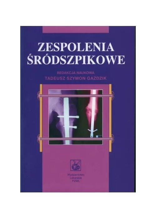 Zespolenia śródszpikowe