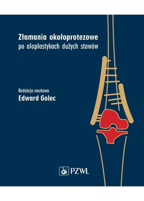 Złamania okołoprotezowe po aloplastykach dużych...