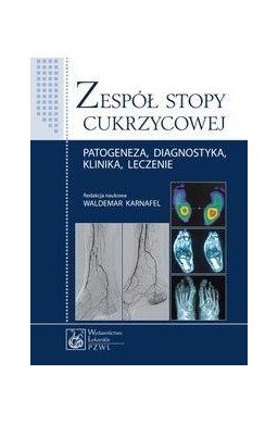 Zespół stopy cukrzycowej