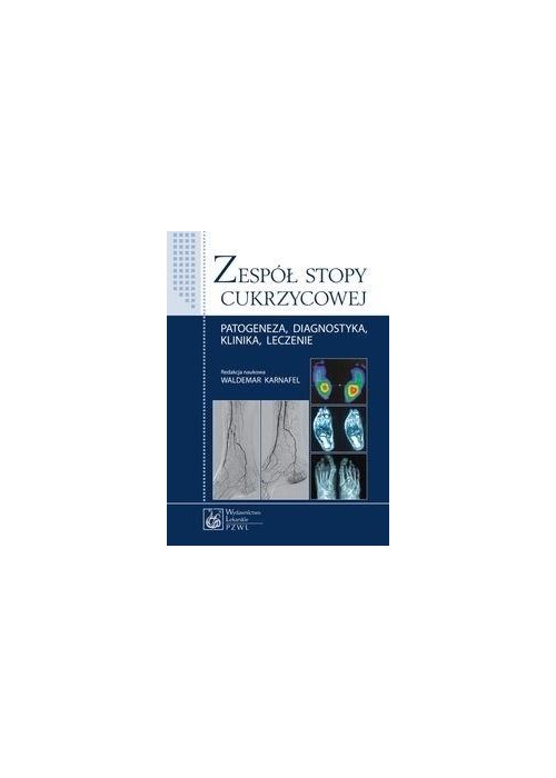 Zespół stopy cukrzycowej