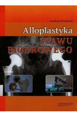 Alloplastyka stawu biodrowego